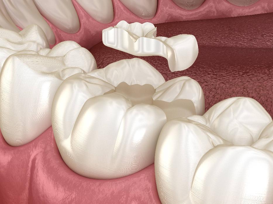 Digital graphic of tooth colored filling restoring cavity in Aston PA