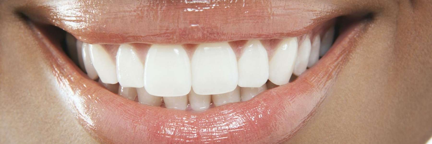 Patient's teeth after professional whitening in Aston, PA