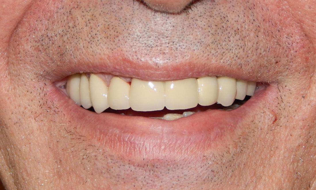 Results from placement of dental bridge in Aston PA