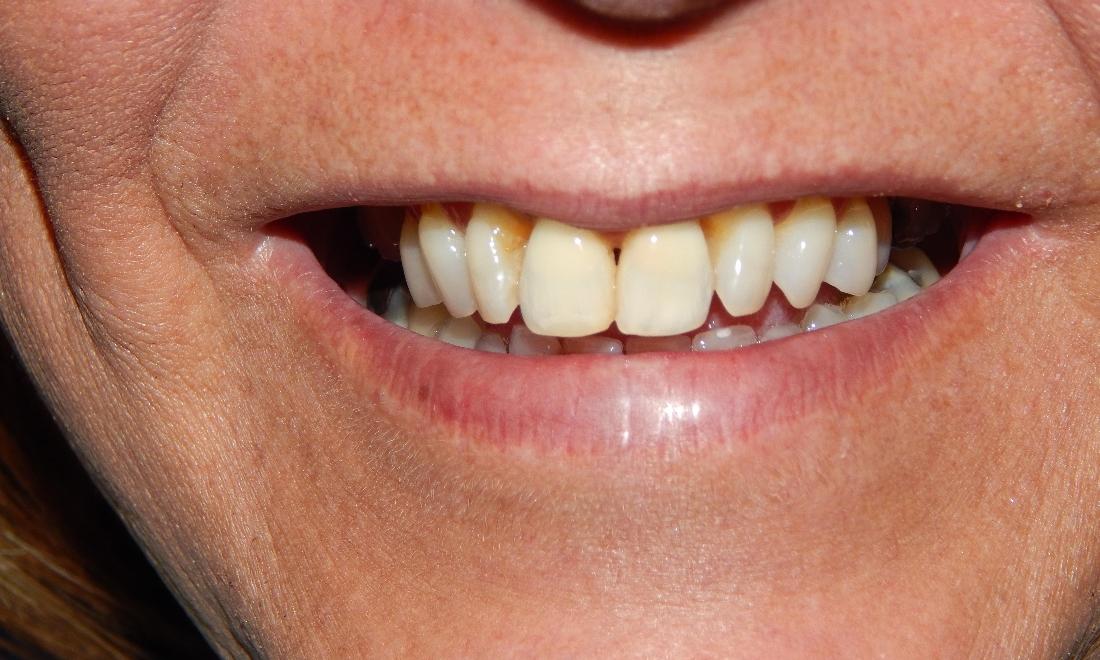 Patient smiling after root canal treatment and internal teeth whitening in Aston PA