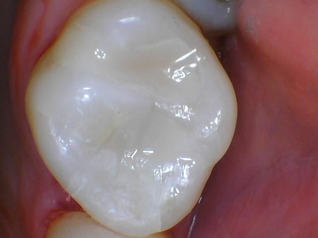 Close up of tooth restored with natural dental fillings in Aston PA