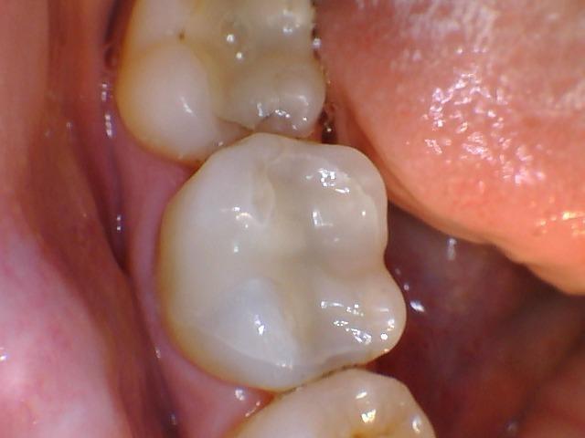 Results from procedure for tooth colored fillings in Aston PA