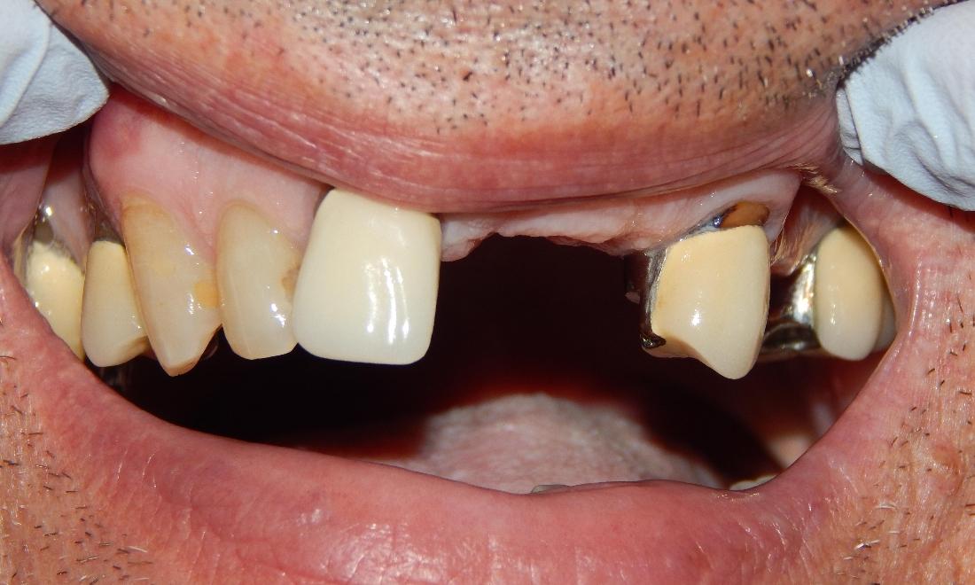 Dental patients smile with missing front teeth at 19014 dentist office