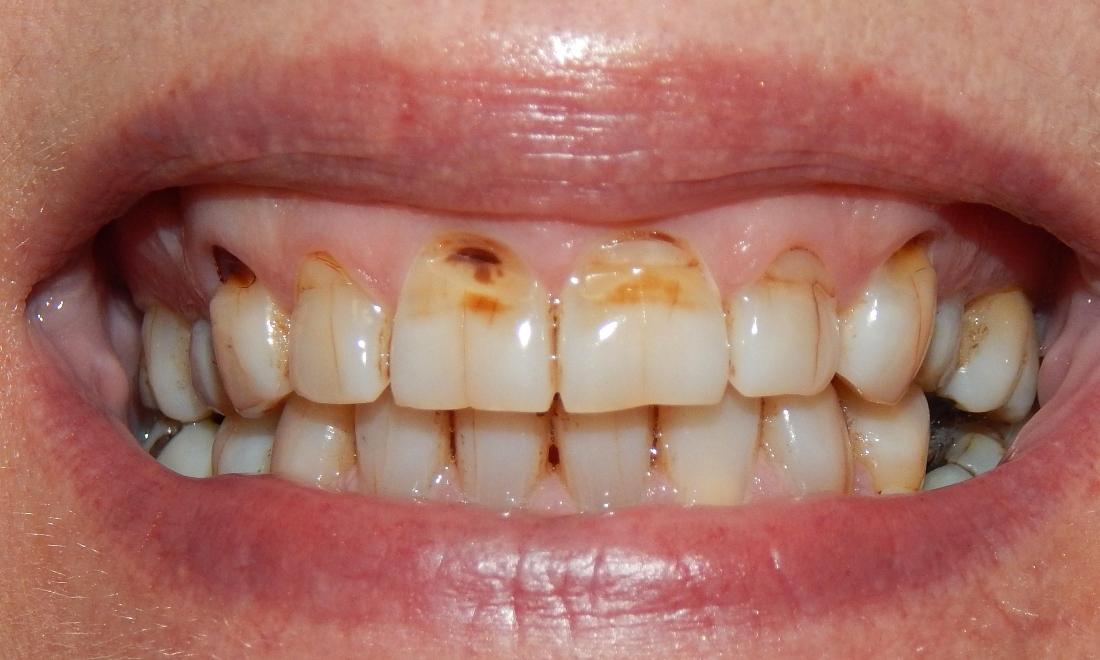 Dental patient with severe tooth decay at Aston PA dentist office